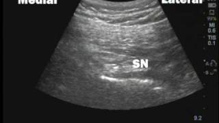 Unintentional sciatic nerve block following pudendal nerve block [upl. by Anhoj]