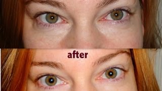 how to get rid of bags under eyes  how to get rid of bags under your eyes  bags under eyes [upl. by Esiled]