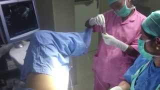 Endometritic Cyst  Chocolate cyst  Ovarian Cyst Removal  ARC Fertility Centre India [upl. by Cave]