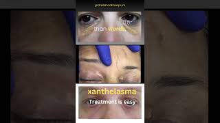 Xanthelasma treatment [upl. by Snej]