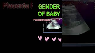 BABY GENDER VS PLACENTA shortsfeedpregnancy [upl. by Ferdinande951]