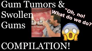 Braces causing gum tumorsswollen gums compilation [upl. by Lourdes]