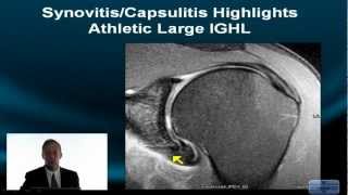 Shoulder MRI Instability Part II How to Deal with Variation Axillary Recess Clefts and Fissures [upl. by Anitnas]