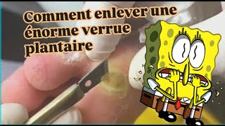 Comment enlever une énorme verrue plantaire [upl. by Callean921]