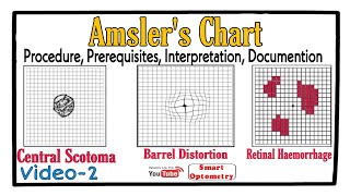 Amslers Chart Procedure Prerequisites Scotoma Interpretation Documention Video2 [upl. by Can]