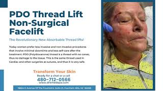 PDO Thread Lift Fountain Hills Arizona Dr Karandish MedSpa [upl. by Litta]