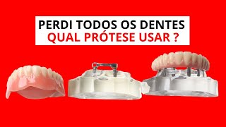 Diferenças entre Prótese Protocolo Dentadura e Overdenture  Dr Guilherme Felix [upl. by Ydroj]