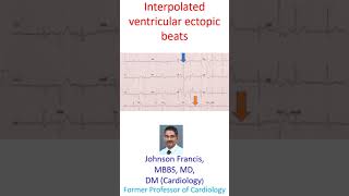 Interpolated ventricular ectopic beats [upl. by Ahsinyt393]