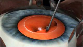 Phacoemulsification Cataract Surgery [upl. by Nicole]