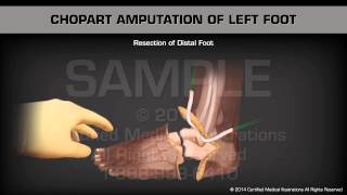 Chopart Amputation Left Foot [upl. by Sanoj]