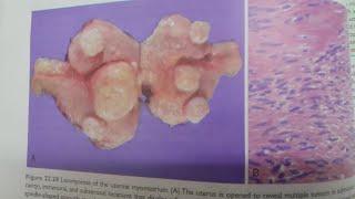 Leiomyoma  SPECIAL PATHOLOGY [upl. by Yrailih]