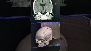 NCCT BRAIN PLAIN [upl. by Vaas]