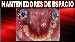 MANTENEDOR DE ESPACIO EN ORTODONCIA Y ODONTOPEDIATRIA ODONTOLOGIA [upl. by Proudfoot]