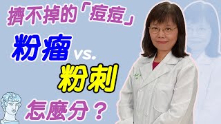 擠不掉的「痘痘」！粉瘤跟粉刺怎麼分？｜好心肝·好健康 [upl. by Teiluj284]