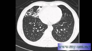 CT Chest  How to differentiate between pulmonary arteries and veins [upl. by Aeuhsoj]