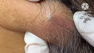 sebaceous cyst behind the neck HoangMySpa78 [upl. by Calabresi198]