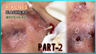 Big Cystic Acne Blackheads Extraction Blackheads amp Milia Whiteheads Removal Pimple Popping [upl. by Lilaj117]