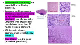 Tuberculous lymphadenitiscervical lymphadenitis Treatment diagnosis and investigations [upl. by Ferne18]