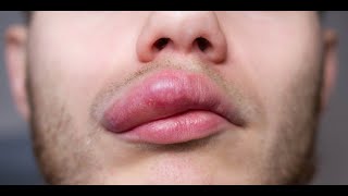 Angioedema  Symptoms and Causes [upl. by Diamante726]