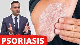 Psoriasis Treatment  The Best 2 Remedies For Psoriasis [upl. by Airamana345]