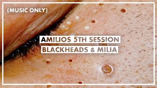 Amilios 5th Session  Blackheads And Milia Extraction On The Face Only With Music [upl. by Roxanne]