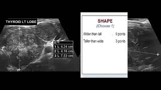 TIRADS 5 Thyroid Nodule with tumor thrombus [upl. by Linn]