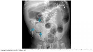 Ileocolic Intussusception Imaging [upl. by Leinehtan]