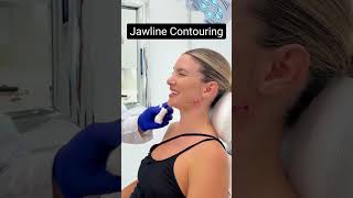 Jawline contouring using fillers [upl. by Mendes]