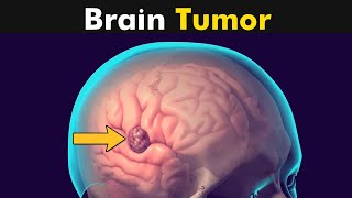 What Happens in Brain Tumor  Symptoms and Causes 3D Animation [upl. by Pail]