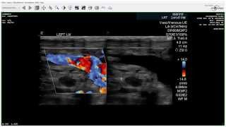 physical exam Newborn Normal PositionsVertical Suspension [upl. by Pauline]