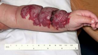 Infantile Hemangiomas aka “Strawberry” Birthmarks [upl. by Damahom514]