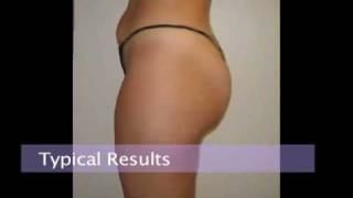 Buttocks Liposuction by Dr Jeffrey A Klein MD [upl. by Hare263]