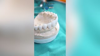 Veneer Show Case 🦷✨ [upl. by Rezzani]