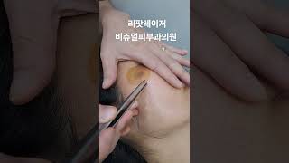 리팟레이저 세종리팟 세종시리팟 청주리팟 공주리팟 대전리팟 비쥬얼피부과 흑자레이저 흑자 대전피부과 세종피부과 세종시피부과 오송피부과 청주피부과 reepot [upl. by Bowers]