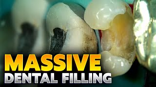 40 Live Restoration of Fractured Dental Filling [upl. by Eenal]