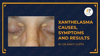 Xanthelasma  Why it happens Causes Prevention Treatment Options Symptoms and Results [upl. by Ethelin]