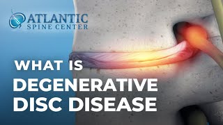 What Is Lumbar Degenerative Disc Disease  Intervertebral Disc Height Loss [upl. by Reagan]