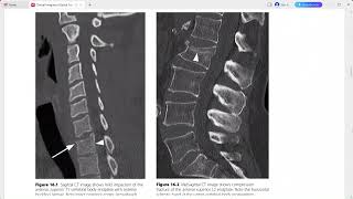 CLINICAL IMAGING OF SPINAL TRAUMA [upl. by Alvan]