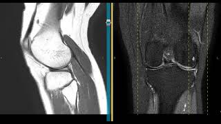 Mucoid degeneration of the lateral meniscus [upl. by Nnaj47]