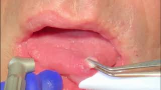 Solea Fibroma removal  Dr Heath Brantley Narrated [upl. by Burford]