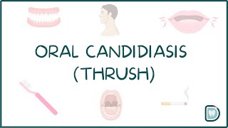 Understanding Oral Candidiasis or Oral Thrush [upl. by Audre]