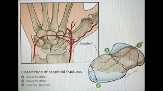 Anatomical basis of Avascular Necrosis of Scaphoid Bone Preisers Disease [upl. by Ydneh]