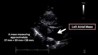 Left Atrial Mass [upl. by Sitoiganap]