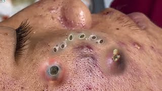 Big Cystic Acne Blackheads Extraction Blackheads amp Milia Whiteheads Removal Pimple Popping 090 [upl. by Shaylah]