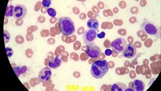 Pure Red Cell Aplasia 4 patients [upl. by Anaila]