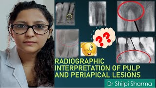 Radiographic Interpretation of Pulp and Periapical Infections। Chairside diagnosis [upl. by Minna]