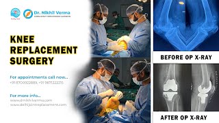 Patient Shares Her Knee Replacement Surgery Experience at Sant Parmanand Hospital  Dr Nikhil Verma [upl. by Mages]