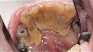 MASSIVE Calculus Buildup  Severe Gum Disease Case [upl. by Annhoj882]