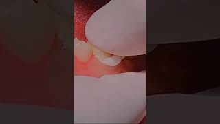 Crown cementation to protect root canal treated teeth dentist teeth tooth dentista dentistteeth [upl. by Elita]