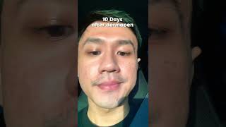 UPDATE AFTER DERMAPEN 15 dermapen dermapenmicroneedling [upl. by Assirram698]